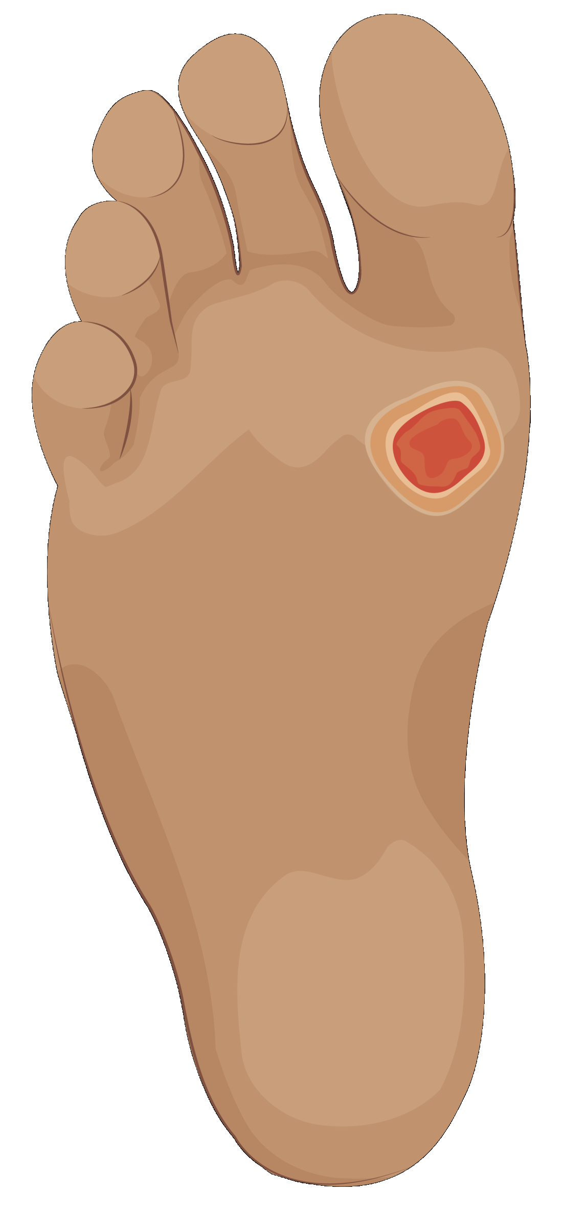 Wound on foot